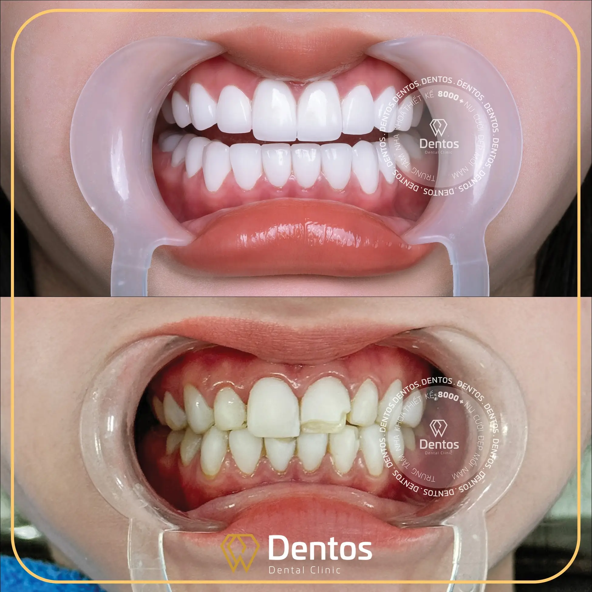 Bọc răng sứ cao cấp giúp thay áo mới hoàn hảo cho nụ cười